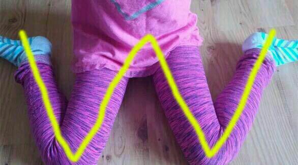  خبراء يحذرون من جلوس الاطفال على شكل (w  ) 