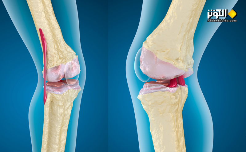 متى تكون الجراحة الحل الأمثل لعلاج تمزق الركبة؟