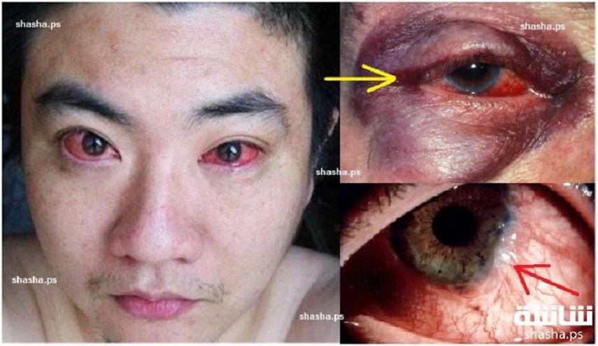 الهواتف الذكية والأصابة بسرطان العين.. إحذر!