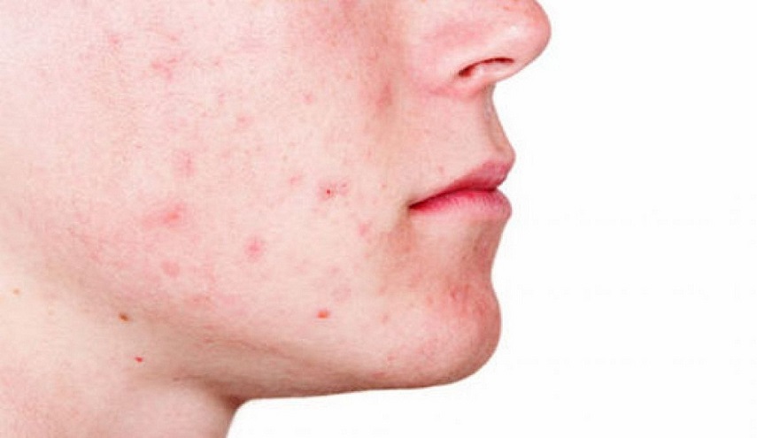طرق علاج حب الشباب بالعسل والقرفة