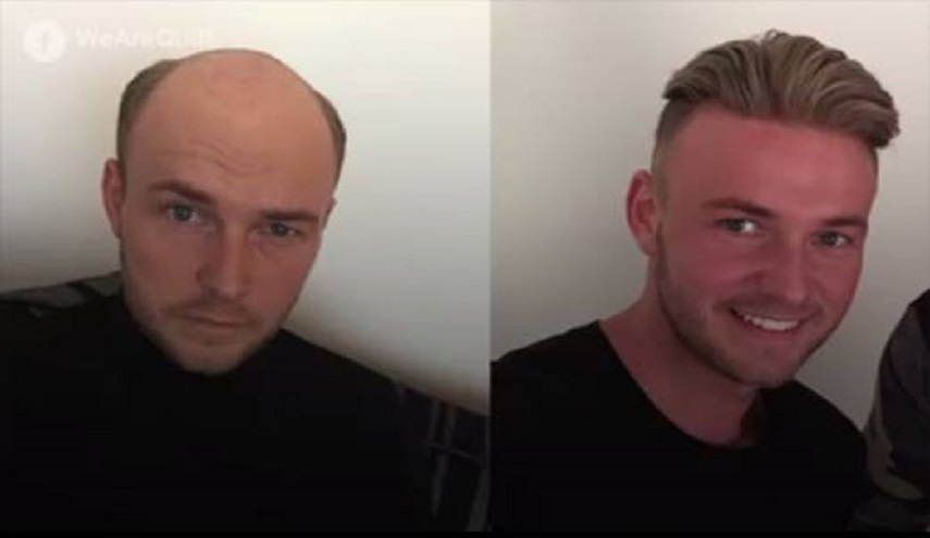 هل تكرهون الصّلع؟ إليكم الحلّ ....