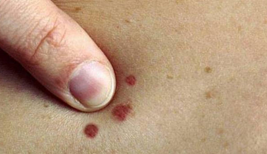 في حال ظهور هذه العلامات الحمراء على جسدك فأنت مهدد بـ..