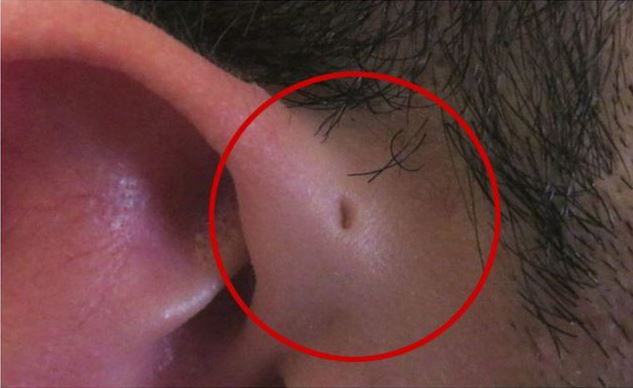 ما سر الثقوب الصغيرة  جانب اذن بعض الناس؟!