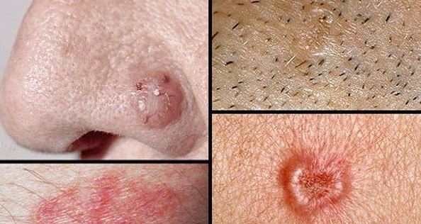 انتبهوا جيّداً .. إذا لاحظتم هذه الإشارات على جسدكم فهي إشارة على الإصابة بالسرطان