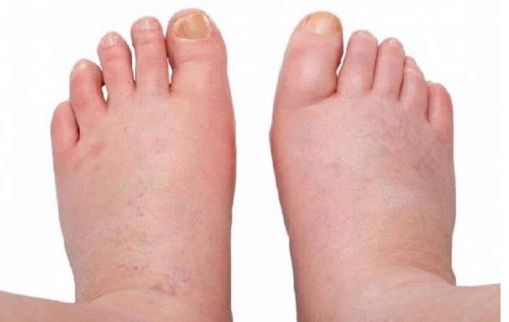 هذا ما يجب أن تأكلوه لتمنعوا احتباس الماء في أقدامكم