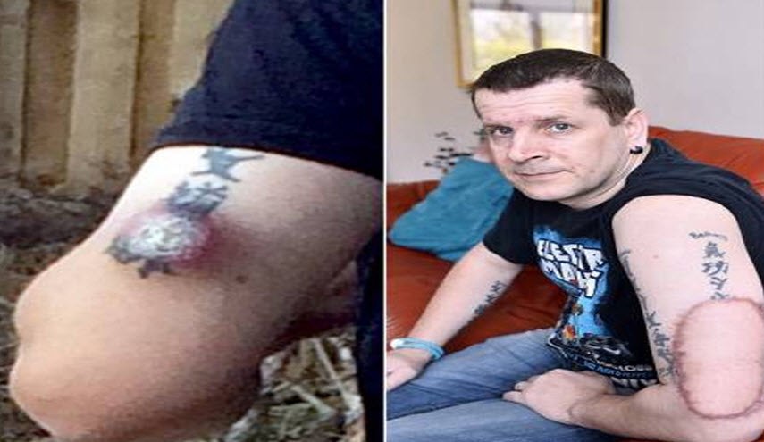 خطير جداً | اعتقد أنها لدغة بعوضة.. لكن عندما ذهب للطبيب كانت الكارثة!