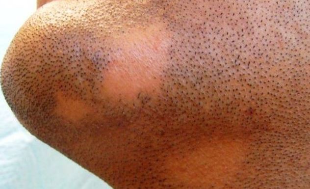 للرجال... هكذا تتخلصون من فراغات الرأس والذقن!