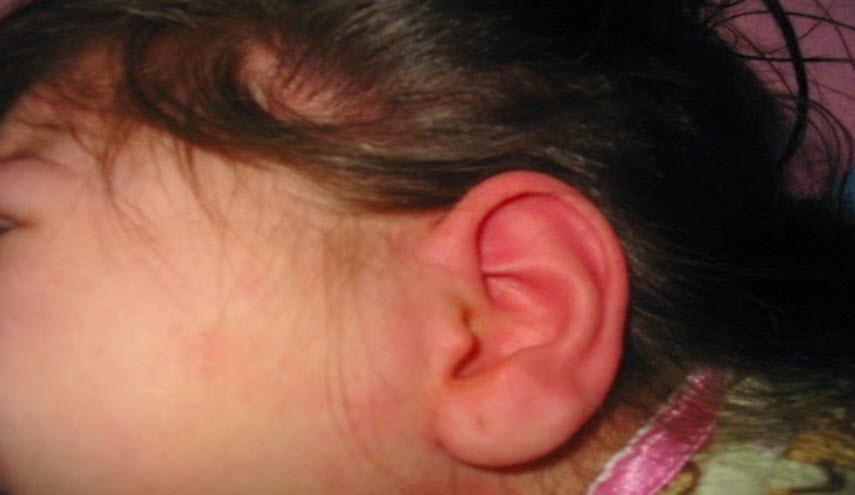 هل تعانون من احمرار الاذن وسخونتها بشكل مفاجئ؟.. هذا هو السبب!