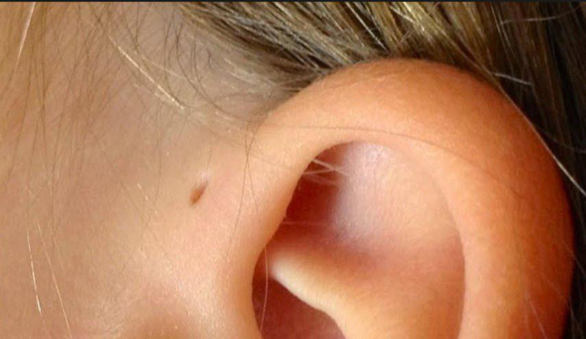 ما سرّ هذا الثقب الذي نراه قرب أذن البعض؟