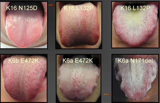 هذه هي الخفايا الصحية التي يكشفها لون لسانكم!