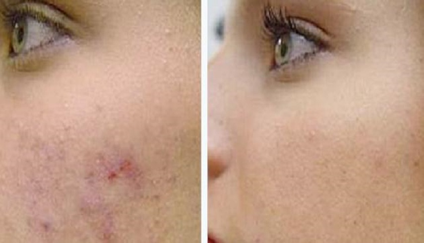 بشرى سارة ... اليكم علاج حب الشباب وكيفية التخلص من آثاره على الوجه؟