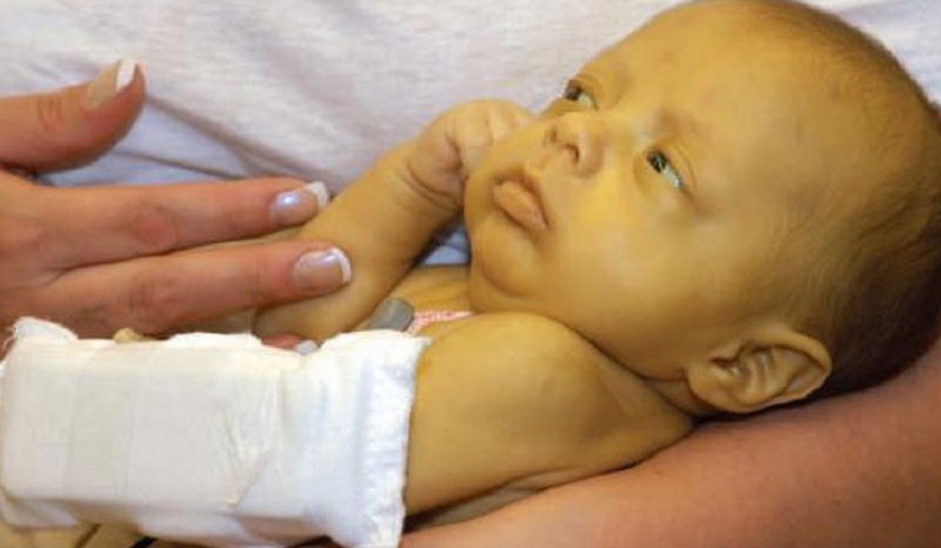 أعراض وأسباب الصفراء عند حديثي الولادة