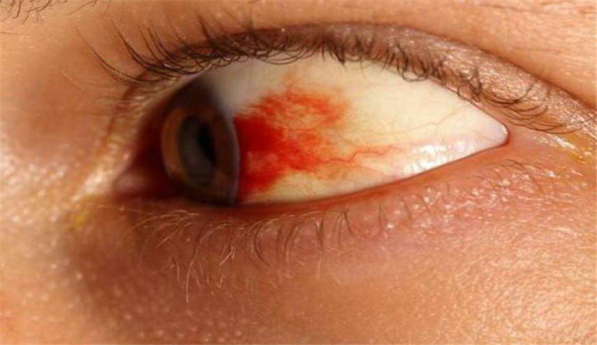 إذا ظهرت هذه العلامات على عينيك.. إستشِر طبيبك حالا!