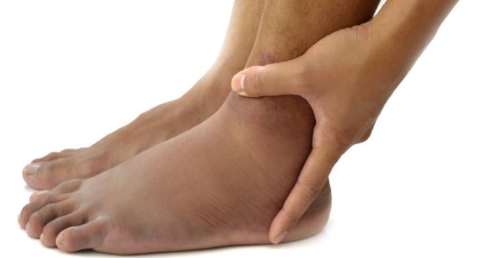 وصفة طبيعية لعلاج مشكلة احتباس الماء في الجسم!