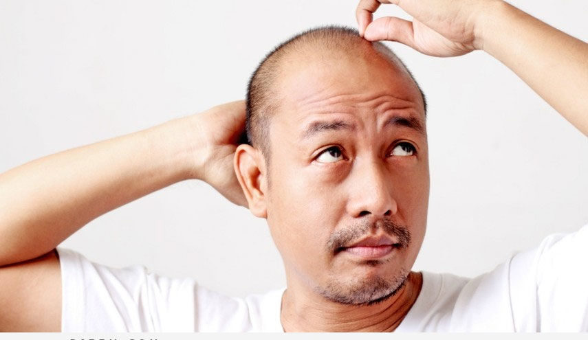 طريقة جديدة وفعالة لمكافحة الصلع...اكتشفها!