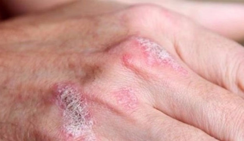 تخلص من الصدفية للأبد باستخدام هذا المحلول..