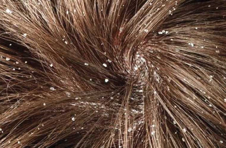 خلطة سحرية تخلصك من قشرة شعر الرأس نهائيا