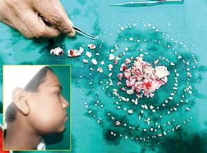 شاهد بالصور ... طبيب يخرج 232 سِنًا من فم مراهق هندي(صور)