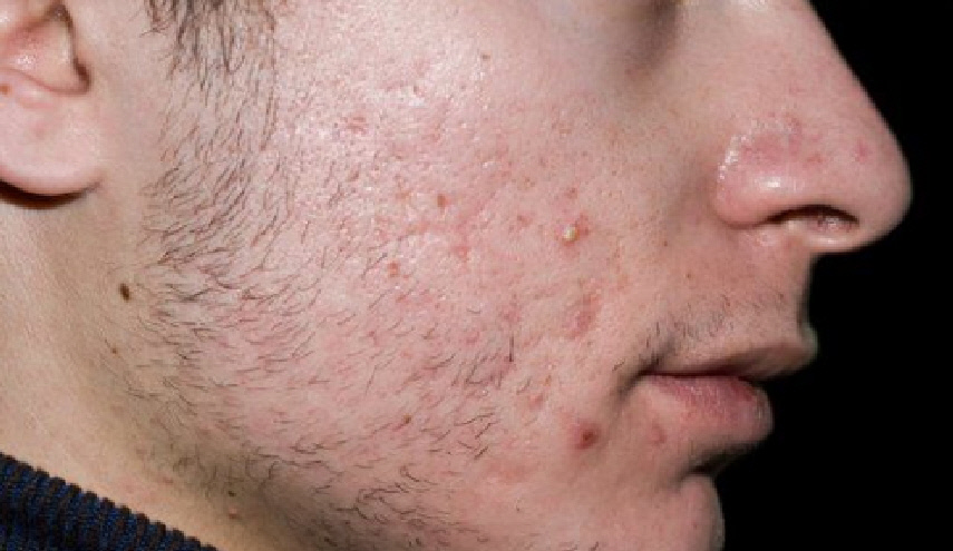 بمكون واحد...  حاربي التجاعيد وحب الشباب 