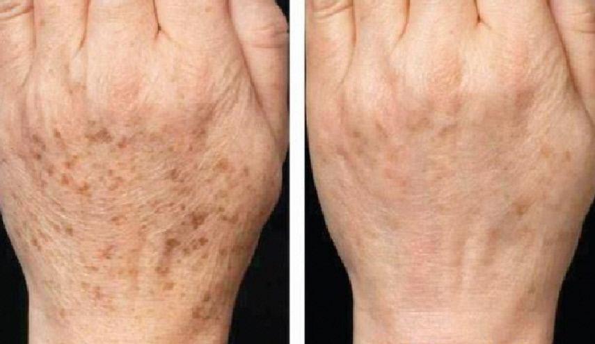 وصفة طبيعية لمكافحة الكلف والبقع البنية