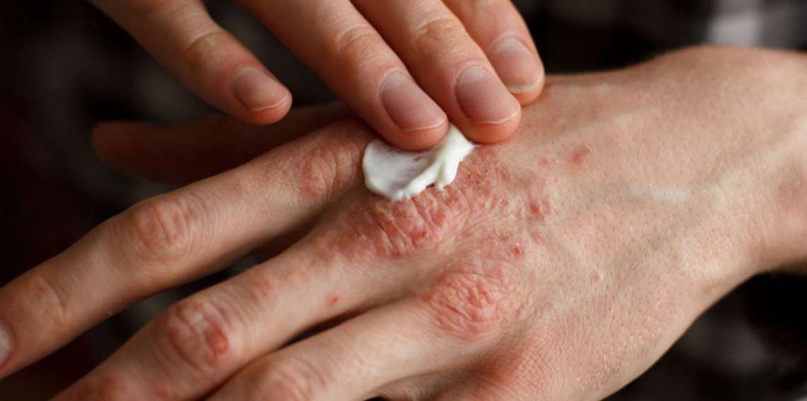 باحثون يتوصلون إلى علاج جديد يقضي على “الصدفية” خلال أسابيع