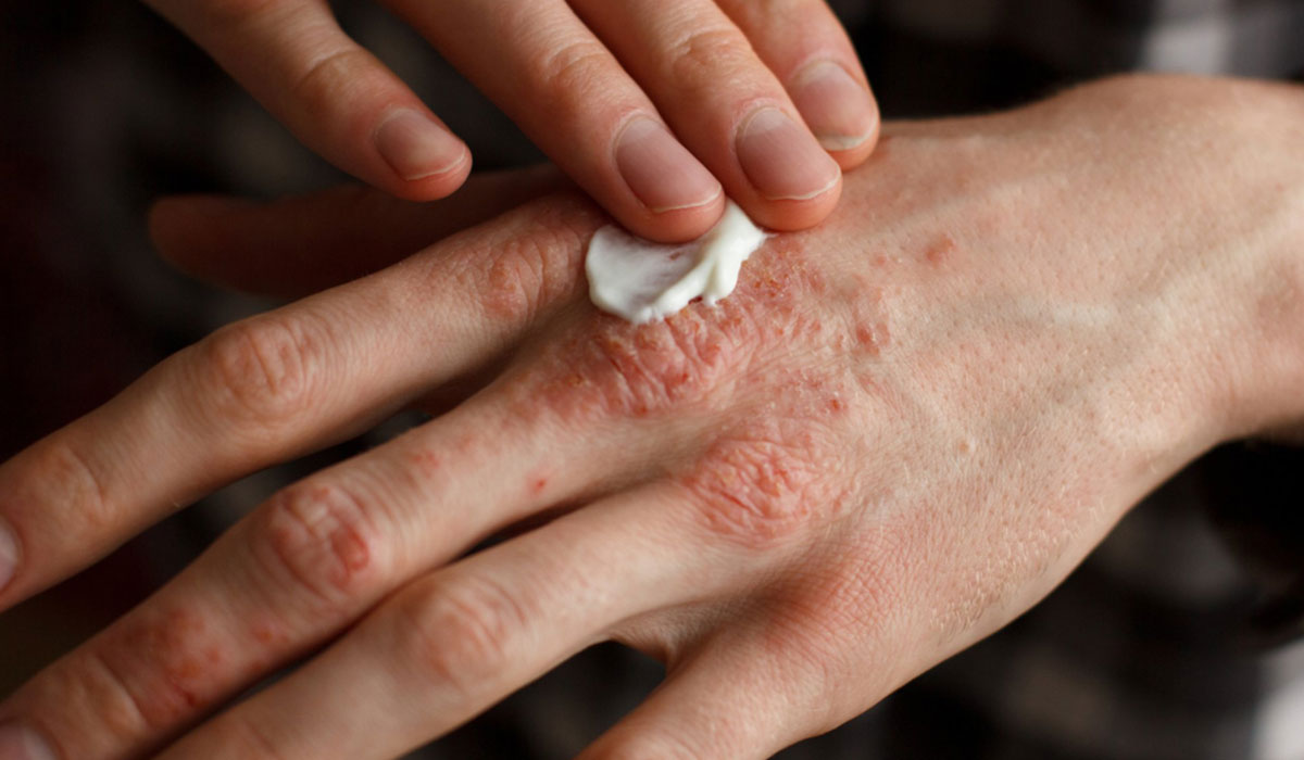 باحثون يتوصلون إلى علاج جديد يقضي على “الصدفية” خلال أسابيع