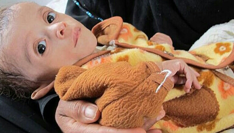 أطباء بلا حدود: التحالف بقيادة السعودية يمنع وصولنا لصنعاء