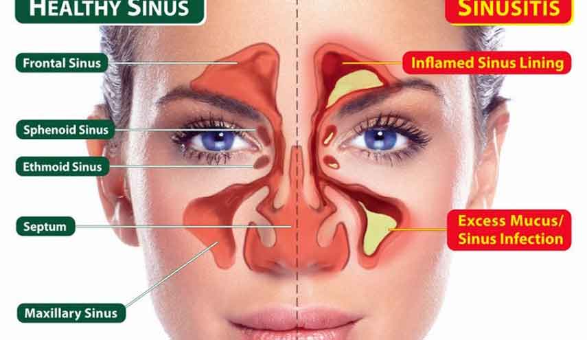 مختص في جراحة الاذن والانف والحنجرة يتحدث عن اسباب التهاب الجيوب الأنفية المزمن