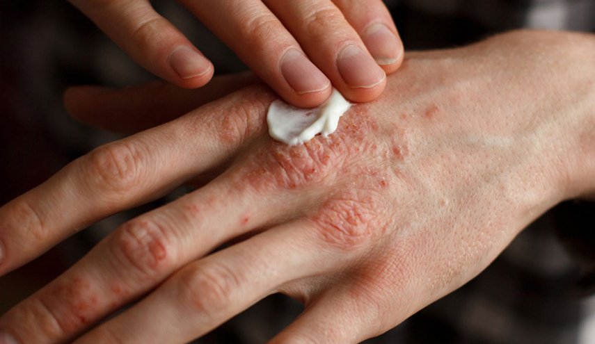 علماء روس يبتكرون دواء فريدا لعلاج الصدفية