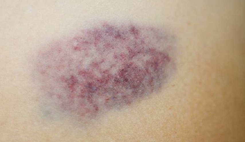 لكل من تظهر عنده هذه الكدمات... اقرا هذا المقال!