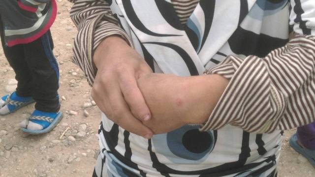 "الجرب" و"حبة بغداد" ينتشران في القائم العراقية