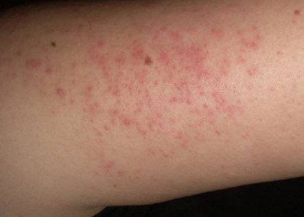 مرض "جلد الدجاجة" لا علاج له... فكيف نخفف من عوارضه؟