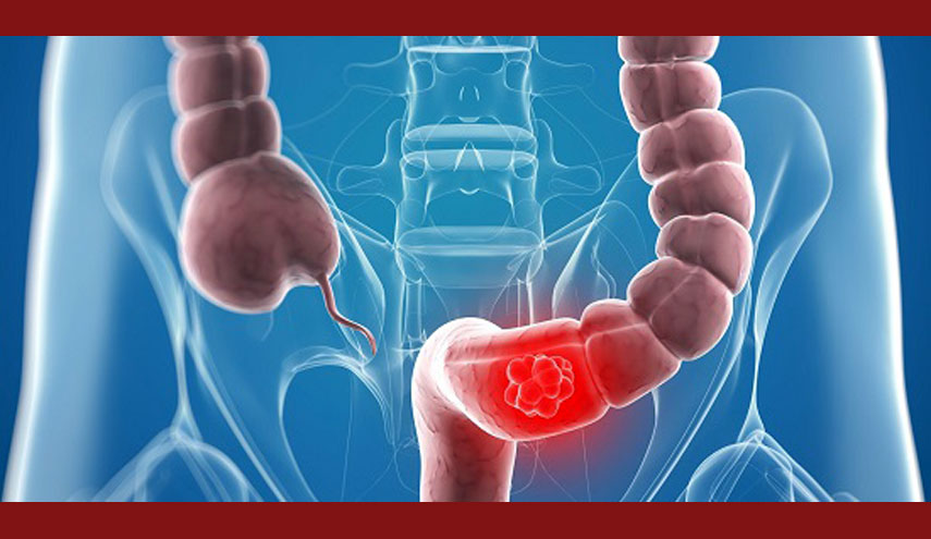 تحذير مهم.. دراسة: هذه هي الاطعمة المسببة للإصابة بسرطان القولون!