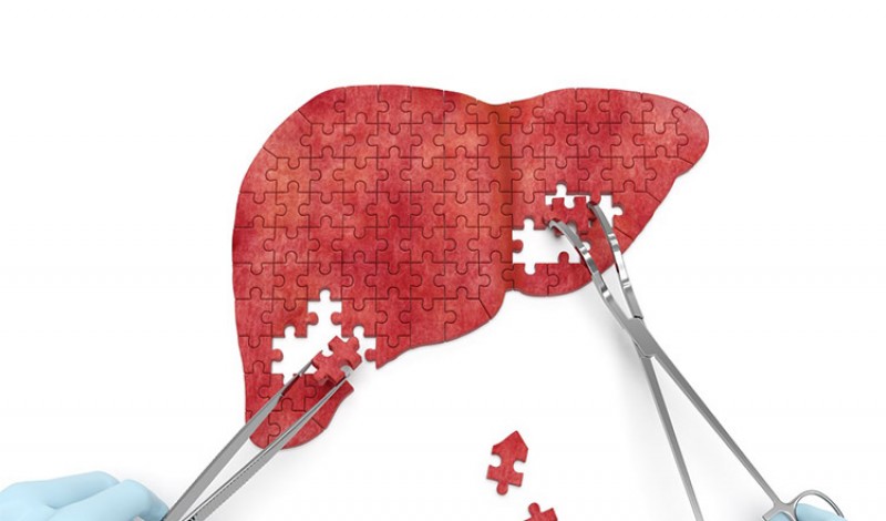 ماهي أسباب الاصابة بـ"الكبد الدهني"؟