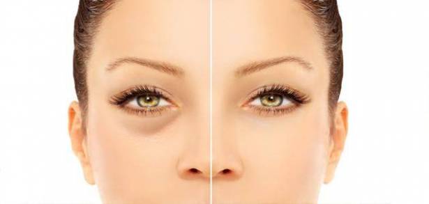  اذا كان لديك هذا الانتفاخ تحت العين اقرأ هذا المقال فوراً؟