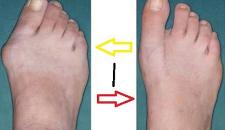  كيف تعالج إعوجاج القدم طبيعياً وبدون جراحة! 