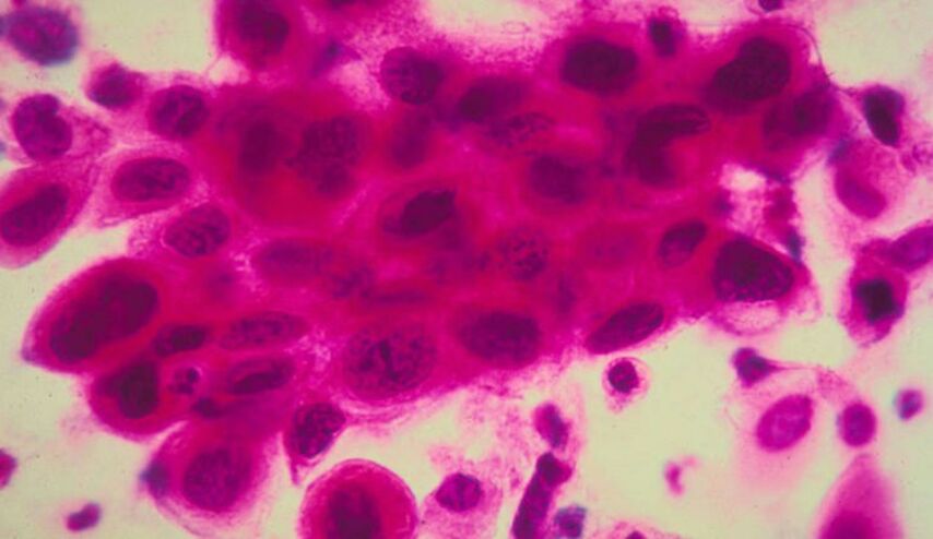 أول لقاح لعلاج السرطان .. اليكم التفاصيل