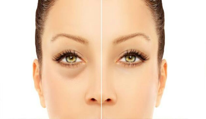 ما سبب انتفاخ العيون؟ وكيف تتخلصين منها؟