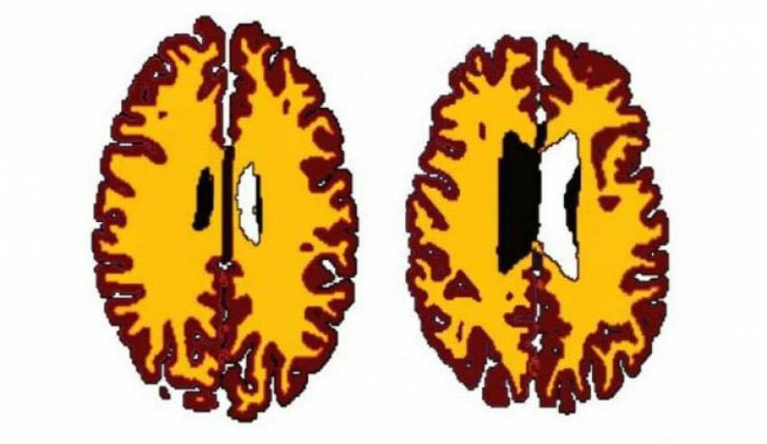 فحص العلماء أدمغة الأشخاص الزائدي الوزن .. ما اكتشفوه مخيف فعلاً!