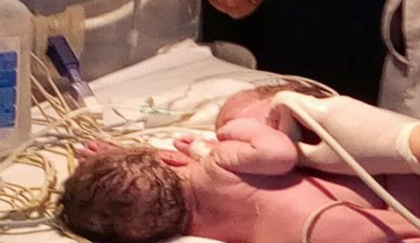  توأم مُلتصق يتقاسم «الكبد والقلب» في المنصورة (صور) 