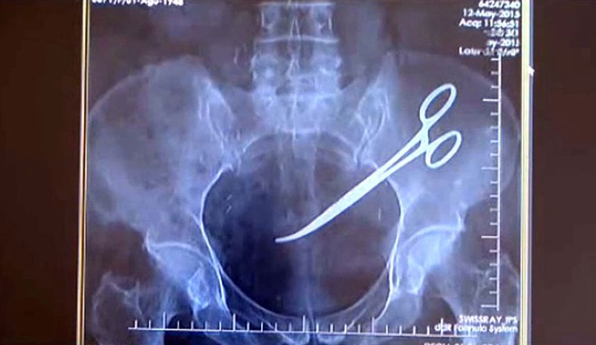 صدق او لا تصدق..بعد 34 سنة يتم إخراج مقص من أمعاء مريض!