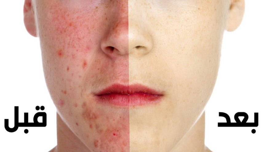 هذه هي أفضل 3 طرق لعلاج حب الشباب