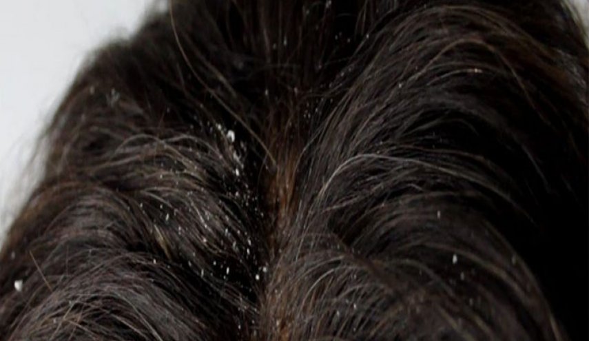 بدون مواد كيميائية.. تخلص من قشرة الرأس بكل سهولة!!