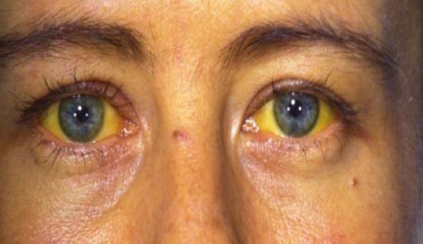  وباء عالمي ينتشر.. 300 مليون إصابة حتى الآن!