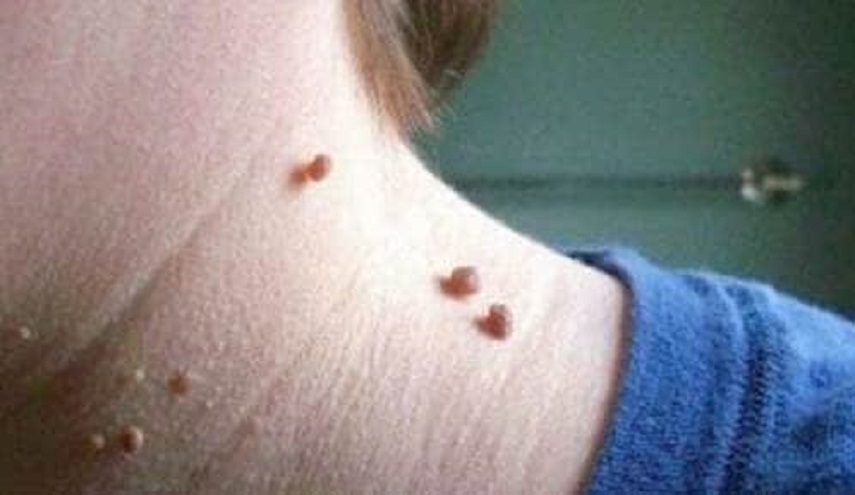 متى تكون الزوائد الجلدية علامة لأورام خبيثة؟