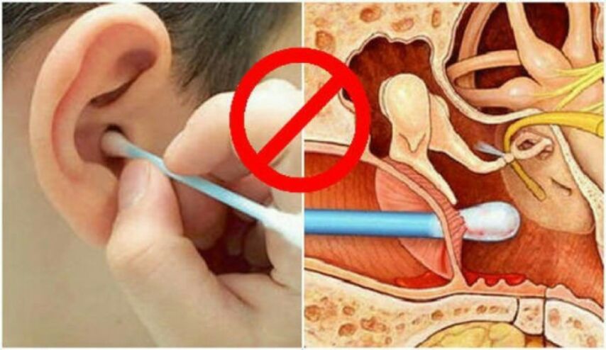 تحذير .. توقفوا عن استخدام أعواد تنظيف الأذن قبل أن تندموا!
