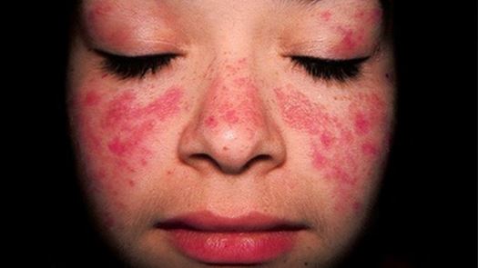 تاثیرات مرگبار  عفونت ویروسی دوران کودکی 