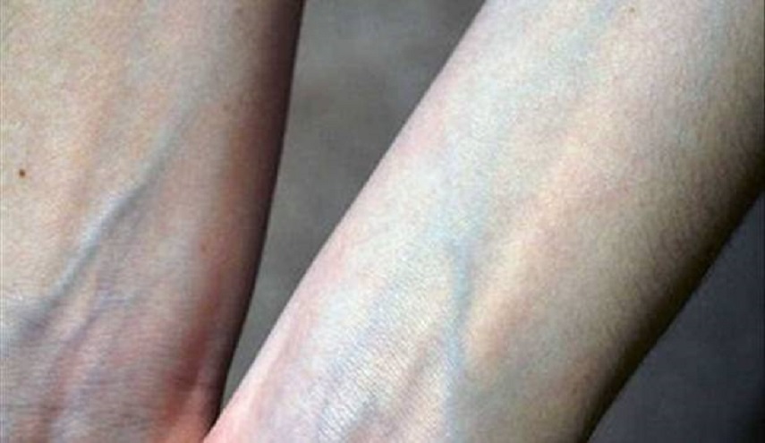  لماذا يظهر الدم بلون أزرق على الجلد رغم أنه في الحقيقة أحمر؟ 