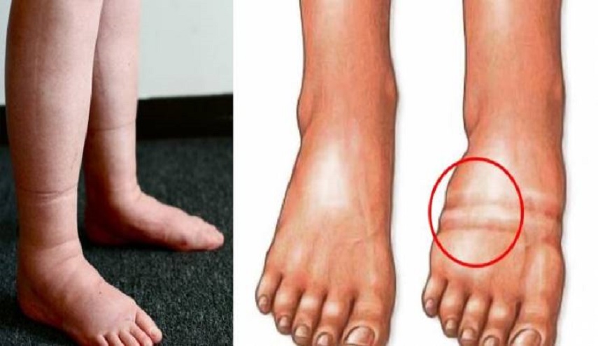  هذه هي العناصر التي تحارب احتباس الماء في الجسم