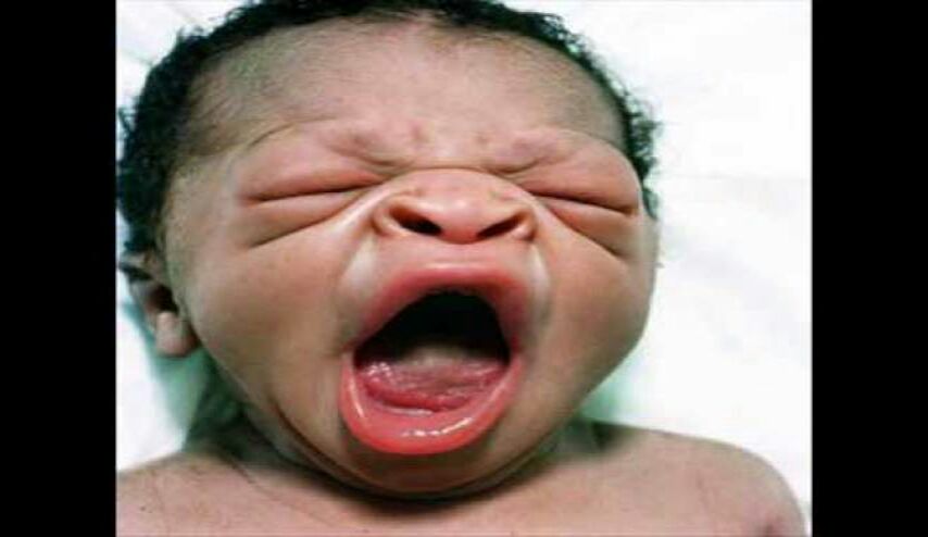 دراسة تكشف سبب ولادة أطفال قبيحي المظهر!